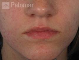 Acne after IPL Treatment